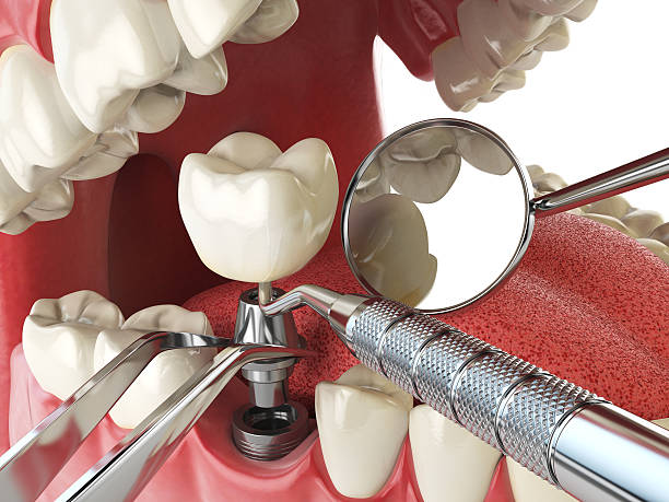 Best Emergency Root Canal Treatment in Negaunee, MI